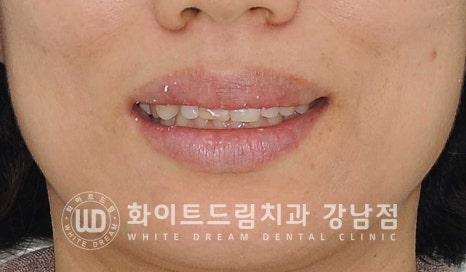 앞니 원데이라미네이트, 뻐드러지고 벌어진 앞니! 당일 치료 ok 관련 이미지 3