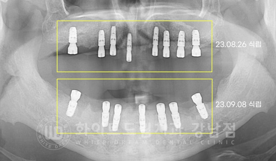 임플란트 재수술 잘하는치과 / 재수술과 전체 임플란트 치료를 동시에! 관련 이미지 7