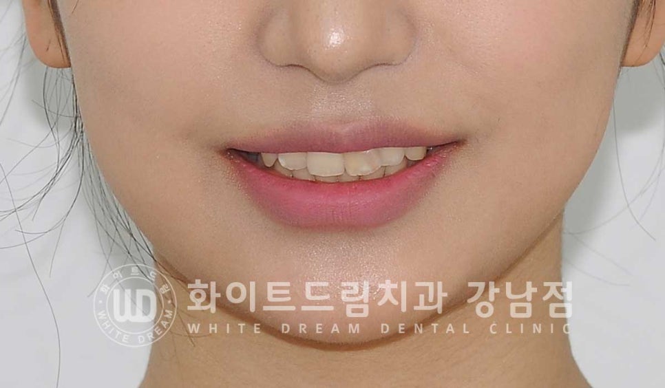 신경치료 후 변색된치아, 라미네이트로 변색과 모양까지 개선! / 강남역화이트드림치과 관련 이미지 7