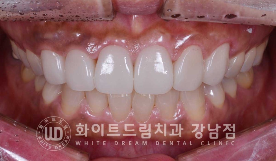 깨진앞니 라미네이트 / 깨지고 누렇게 변한 앞니는? 원데이 라미네이트 치료 사례 관련 이미지 14