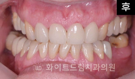 신논현역 당일 라미네이트, "길이가 다른 깨진 앞니" 당일 앞니 라미네이트 치료 과정은? 관련 이미지 17