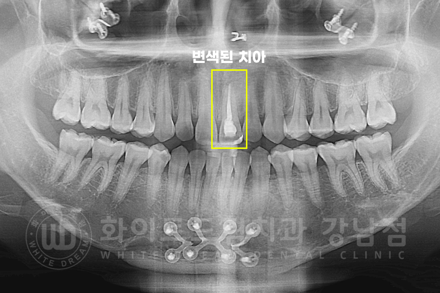 강남역 주변 치과 "10년 된 앞니가 변색됐어요" 앞니 심미 치료 관련 이미지 6