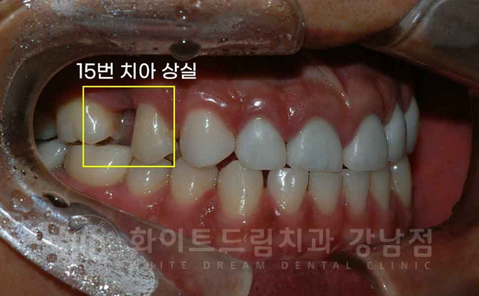 역삼역 앞니 치료  "예전에 한 크라운, 라미네이트 바꾸고 싶어요" 라미네이트 & 크라운 재치료 관련 이미지 6