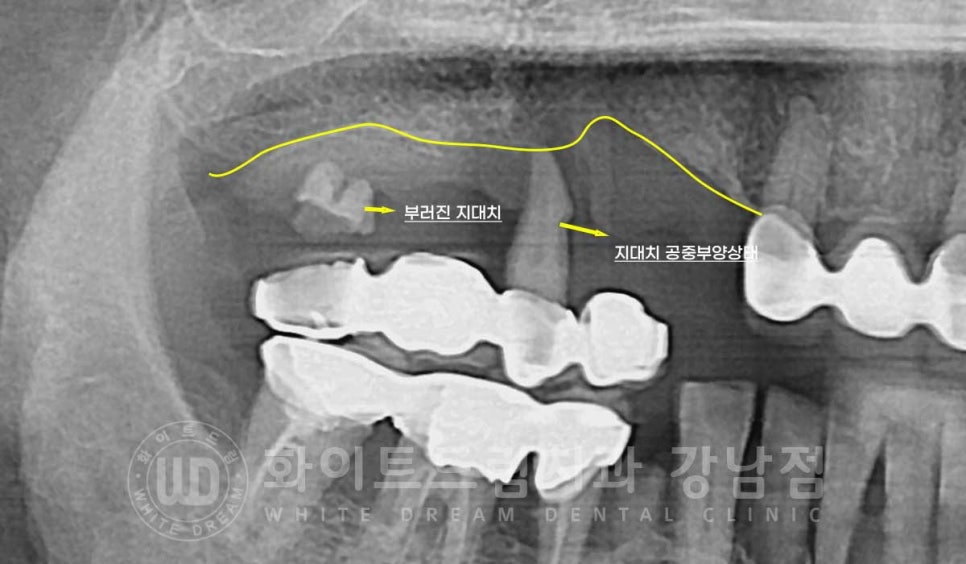 임플란트 1차 수술, 2차 수술이란 무엇일까? (+ 상악 전체 임플란트 치료 기간) 관련 이미지 5