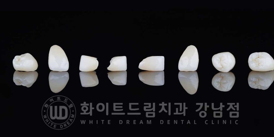 신경치료 후 변색된치아, 라미네이트로 변색과 모양까지 개선! / 강남역화이트드림치과 관련 이미지 1
