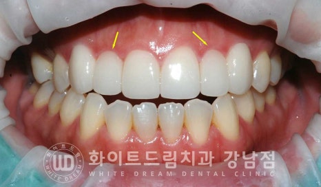 앞니 레진변색 "너무 지저분해 보여요." 라미네이트로 깔끔하게 교체한 치료 사례 관련 이미지 8