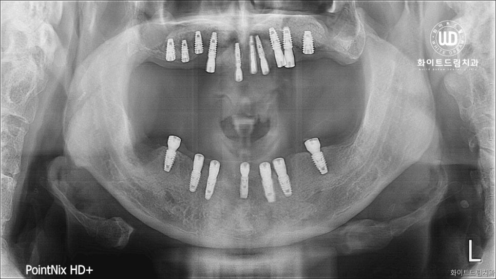 무너진 잇몸뼈와 치아 상실을 대체하는 전악임플란트 치료 사례 관련 이미지 5