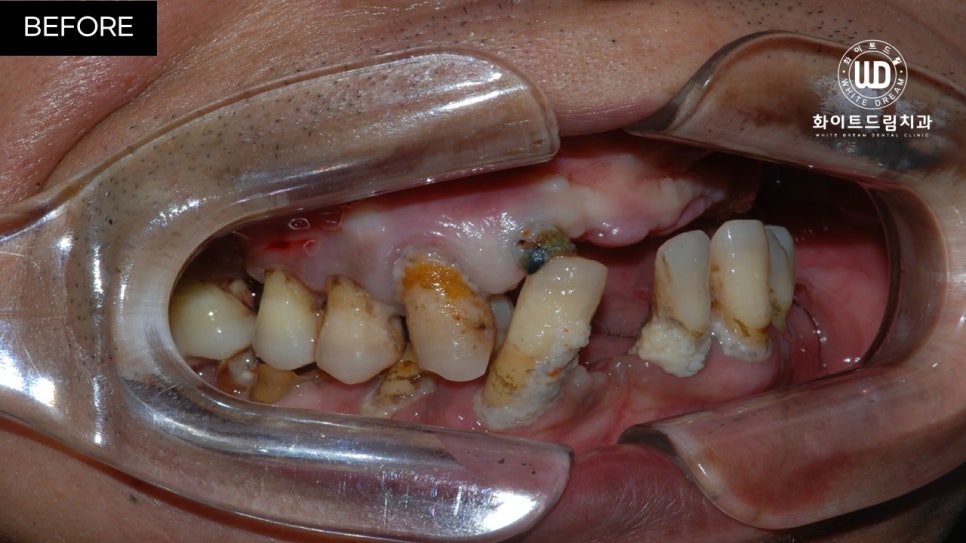 전체임플란트 식립 및 임플란트뼈이식 후기 관련 이미지 7