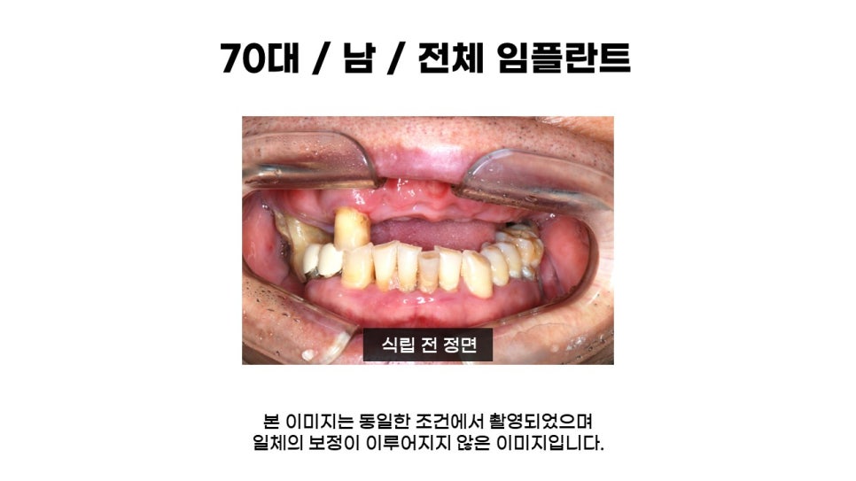 고연령 전체임플란트 과정 및 임플란트 치료기간, 전체임플란트식립후기 관련 이미지 1