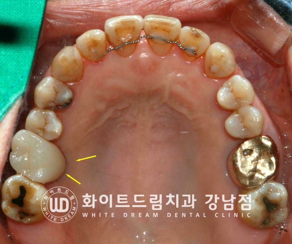 Why You Must Know About "Sinus Lift" Before Upper Molar Implants image 7