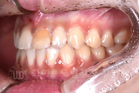 강남역 주변 치과 "10년 된 앞니가 변색됐어요" 앞니 심미 치료 관련 이미지 3