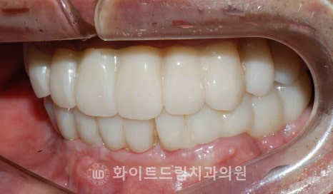 서울전체임플란트잘하는치과, 왜 치주염이 심해지면 반대교합까지 생길까요? (치주염 전체 임플란트 CASE) 관련 이미지 23