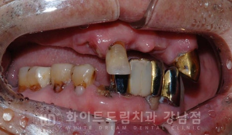 전체 임플란트 치료 기간과 내원 횟수는? "치과에 자주 가기 어려워요." 관련 이미지 26