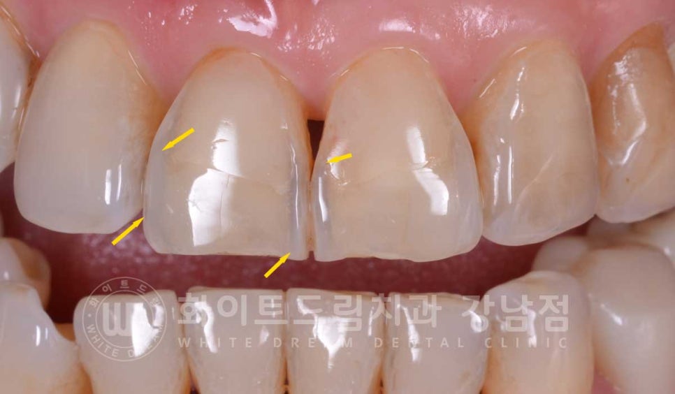 노화된 치아 라미네이트 / 치아미백을 해도 하얘지지 않는 마모된 치아는 어떻게 할까? 관련 이미지 7