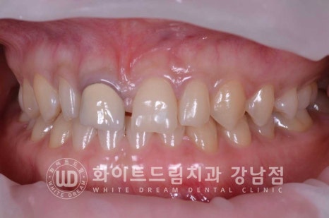 벌어진 앞니라미네이트 / "왜소치로 치아가 벌어졌어요" 치료 사례 관련 이미지 10
