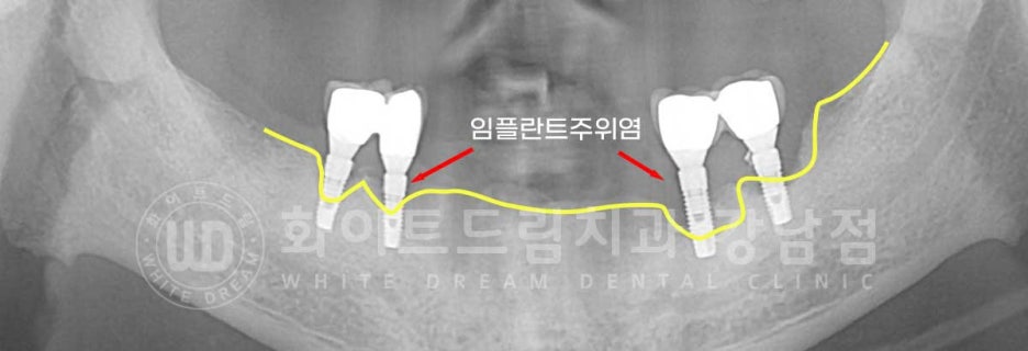 Gangnam Station Dental Clinic Specializing in Implant Revision Surgery—Revision Surgery and Full-Mouth Implant Treatment at the Same Time! image 6