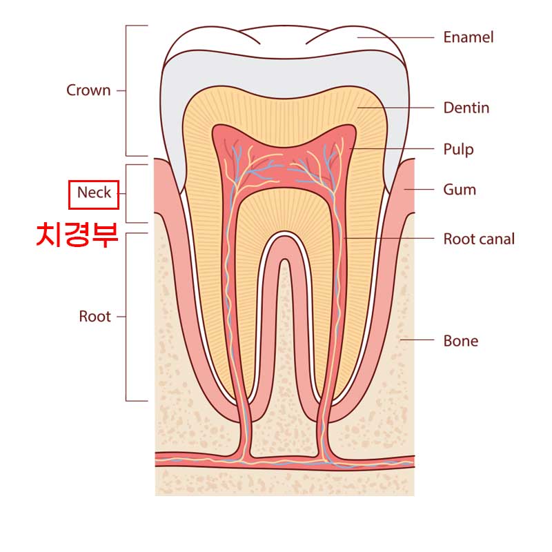 신논현라미네이트, 중년 충치치료, "치경부 우식증, 라미네이트로 당일 치료 OK" 관련 이미지 5