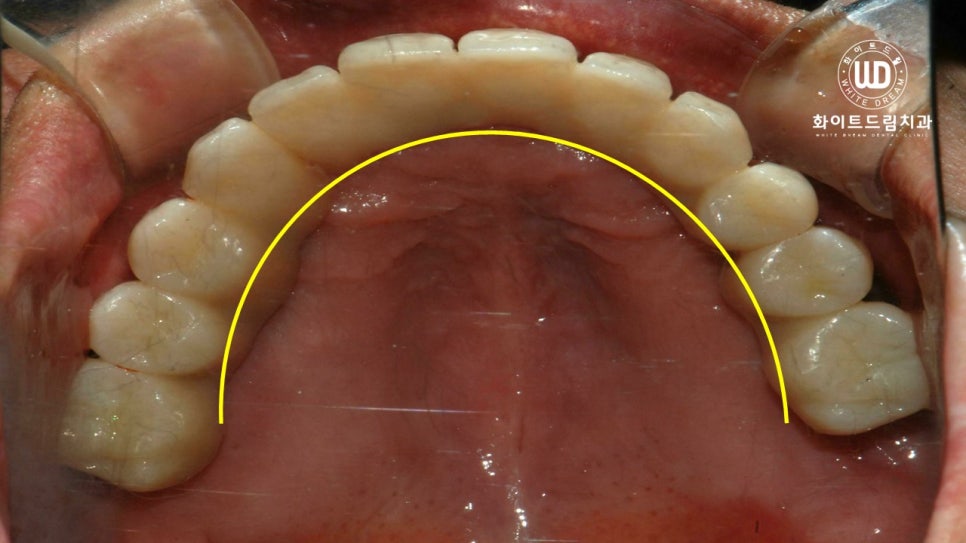 무너진 잇몸뼈와 치아 상실을 대체하는 전악임플란트 치료 사례 관련 이미지 11