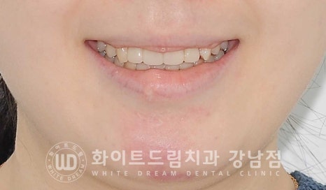 앞니 빠짐 임플란트 / 사고로 인한 앞니 탈구. 앞니 임플란트 치료는? 관련 이미지 12