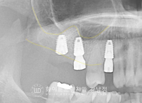 신경치료 후 크라운을 해야 하는 이유 / 크라운을 안 해 부러진 치아 임플란트 치료 case 관련 이미지 15
