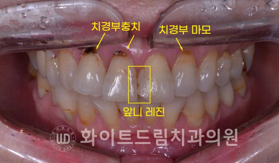 신논현라미네이트, 중년 충치치료, "치경부 우식증, 라미네이트로 당일 치료 OK" 관련 이미지 4