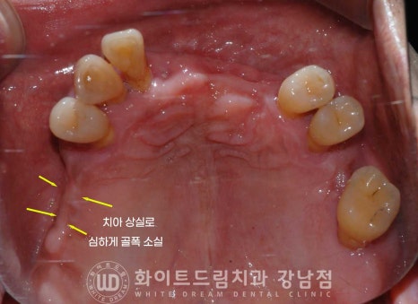 치주염 전체임플란트, 염증으로 인한 상악동 천공 & 신경관 가까이 녹은 잇몸뼈. 임플란트 식립 가능할까? 관련 이미지 6
