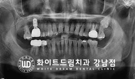 상악 어금니 임플란트 치료 시 동반되는 "상악동 거상술" 이란? 관련 이미지 13