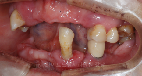 강남역 임플란트 치과 "틀니가 안 맞아서 불편해요" 틀니 → 전체 임플란트로! 관련 이미지 4