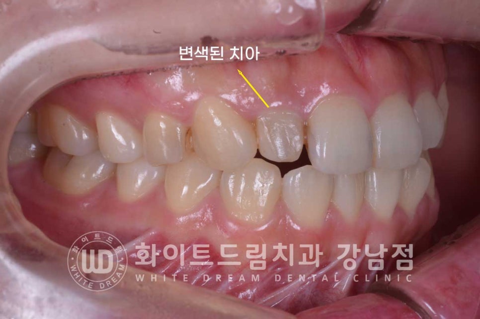 신경치료 후 크라운을 씌워야 하는 이유 & 신경치료 후 변색 치료 Case 리뷰 관련 이미지 4