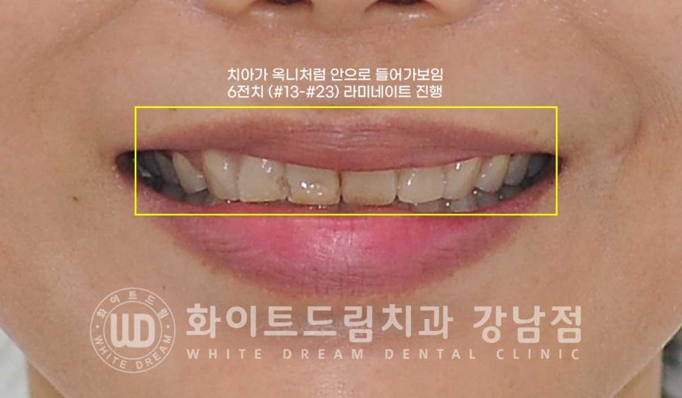 깨진앞니 라미네이트 / 깨지고 누렇게 변한 앞니는? 원데이 라미네이트 치료 사례 관련 이미지 7