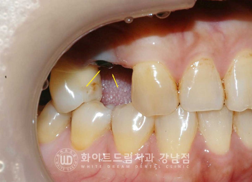 신경치료 후 크라운을 해야 하는 이유 / 크라운을 안 해 부러진 치아 임플란트 치료 case 관련 이미지 9