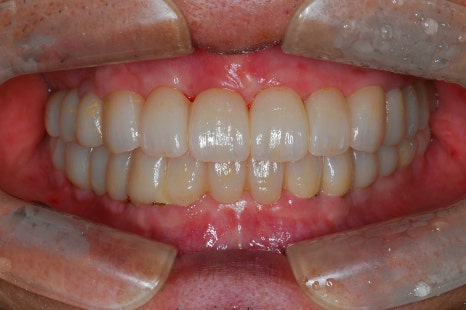 임플란트 하기 전 알아보아야 할 것. 관련 이미지 18