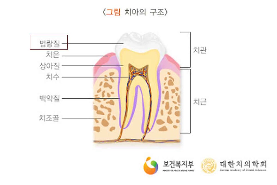 법랑질형성부전증, 라미네이트로 개선해요! / 강남역 라미네이트 치과 관련 이미지 1