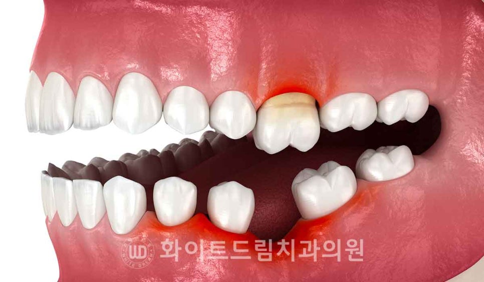 강남역치과 임플란트 "발치 후 바로 임플란트가 가능한 경우 vs 기다려야 하는 경우" 관련 이미지 6