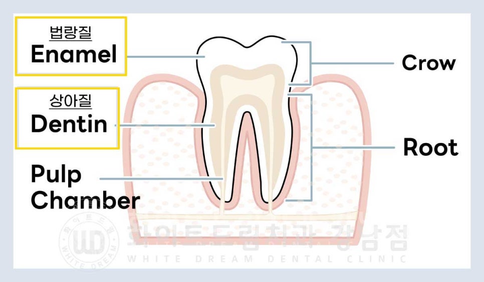 노화된 치아 라미네이트 / 치아미백을 해도 하얘지지 않는 마모된 치아는 어떻게 할까? 관련 이미지 3