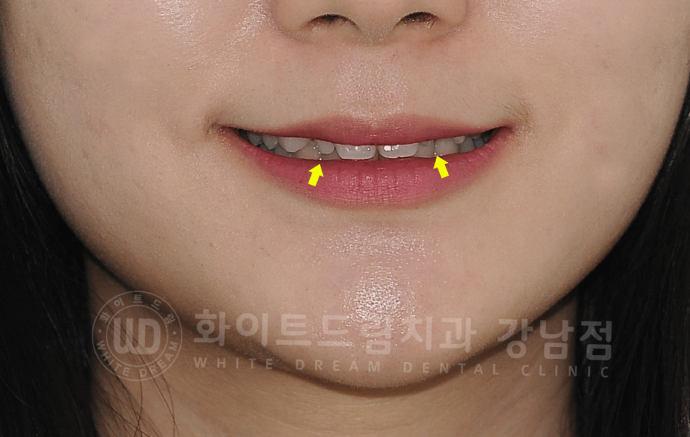 강남역 심미치과 "치아 하나가 유난히 작아요" #왜소치라미네이트 관련 이미지 1