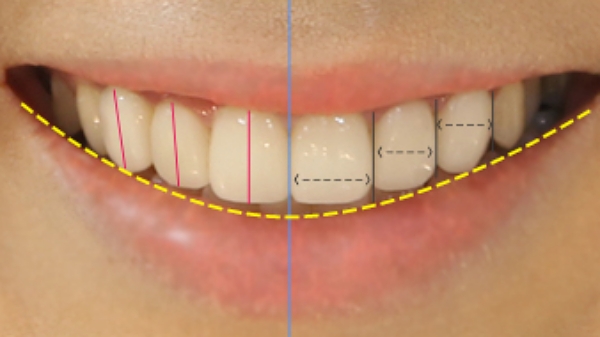 라미네이트 치료에 대해 알아보면? 관련 이미지 3