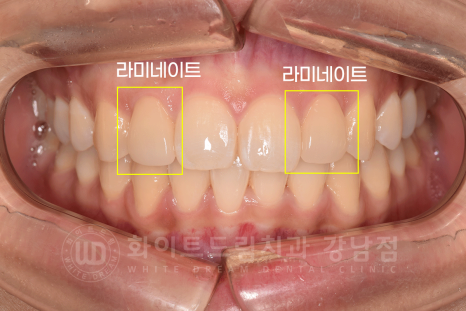 신논현역 라미네이트 / 과개교합 치아교정 + 왜소치 라미네이트 진행 case 관련 이미지 12