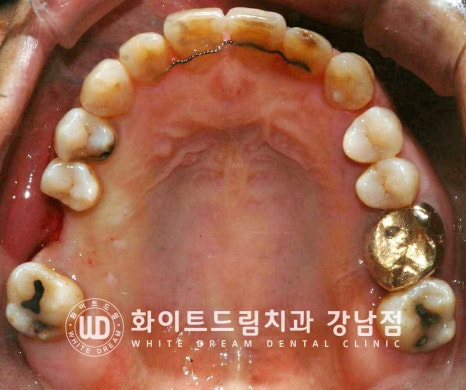 상악 어금니 임플란트 치료 시 동반되는 "상악동 거상술" 이란? 관련 이미지 10