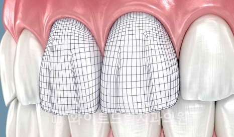 강남역 잇몸성형, 라미네이트와 흔히 동반되는 관련 이미지 10