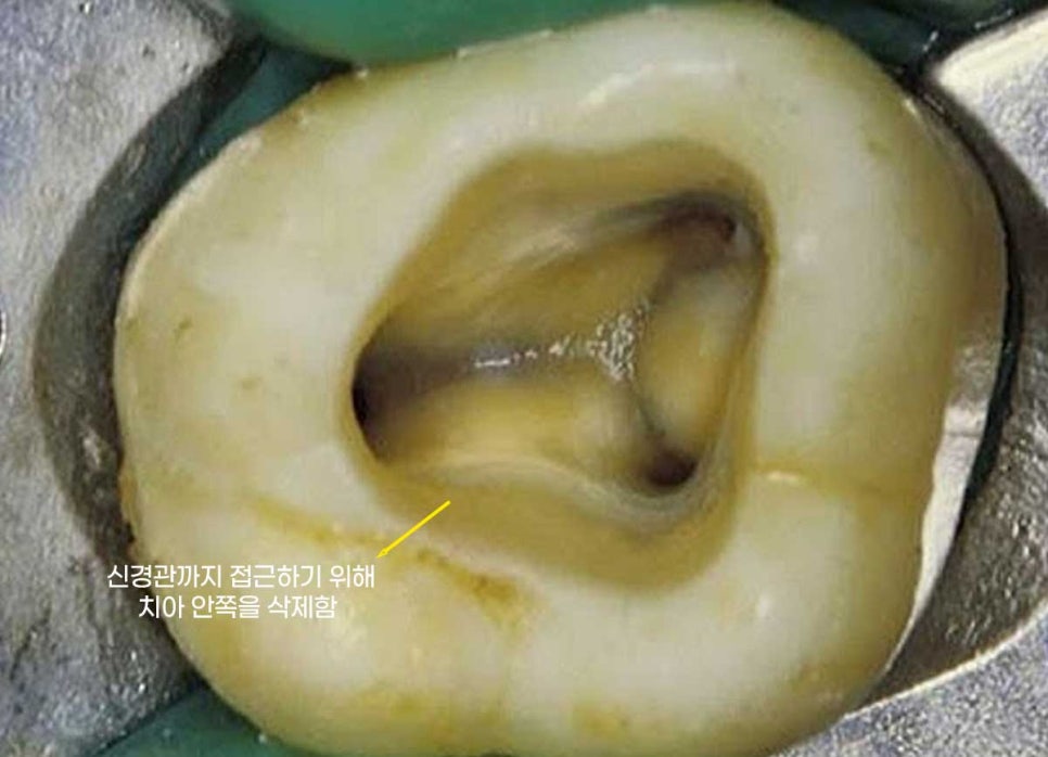 신경치료 후 크라운을 해야 하는 이유 / 크라운을 안 해 부러진 치아 임플란트 치료 case 관련 이미지 3