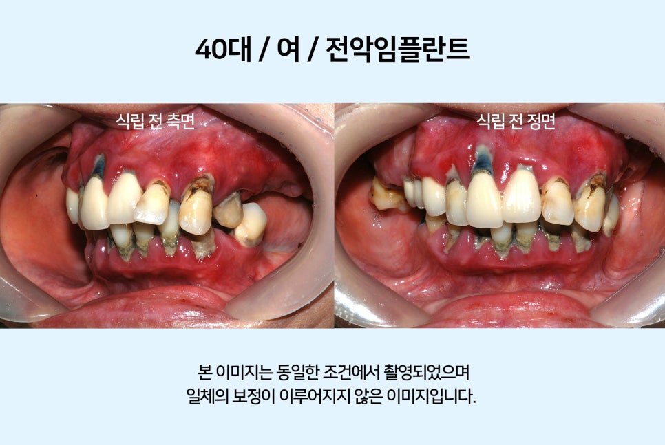 40대 전악 임플란트 식립 증례 관련 이미지 1
