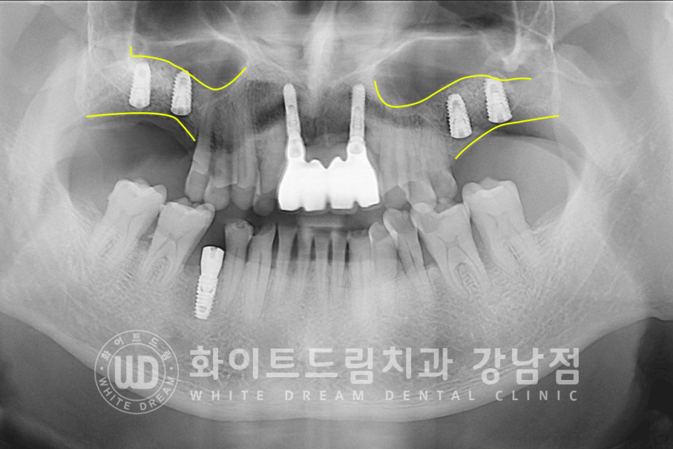 강남역 임플란트치과 / "어금니가 없고 이갈이가 심해요" 강남역 화이트드림치과 관련 이미지 4