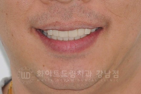 상악동거상술 잘하는치과, 강남역 화이트드림치과 상악동 함기화로 인한 거상술 치료 리뷰 관련 이미지 5