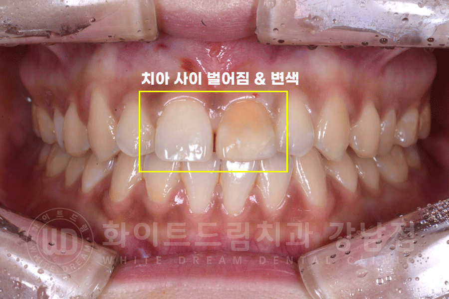 강남역 주변 치과 "10년 된 앞니가 변색됐어요" 앞니 심미 치료 관련 이미지 7