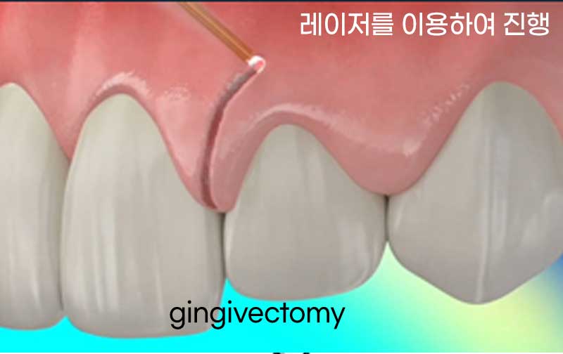 벌어지고 깨진 앞니, 웨딩 앞니 라미네이트 치료 사례 "남자도 자연스럽게 라미네이트 가능한가요?" 관련 이미지 8