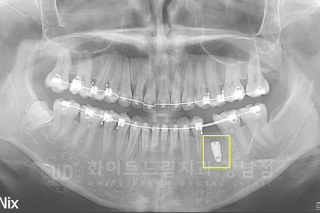 강남 덧니 비발치교정 / 임플란트와 치아교정 동시 진행 case 리뷰. 관련 이미지 14