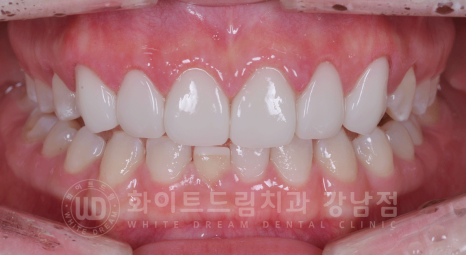 강남역 라미네이트 "치아가 작고 벌어졌어요" 거미스마일 + 벌어진 치아 개선 관련 이미지 4