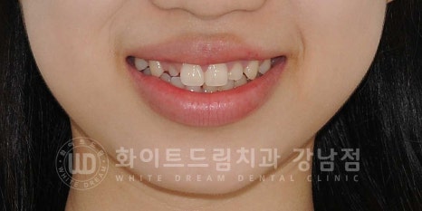 역삼역 왜소치치료 / 치아 하나가 너무 작아요. 왜소치 라미네이트 잘하는 치과 관련 이미지 4