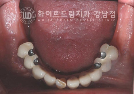 상악 풀케이스임플란트 사례 "부산에서 강남까지 왔어요" 관련 이미지 20
